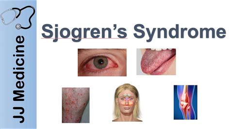dating with sjogrens syndrome